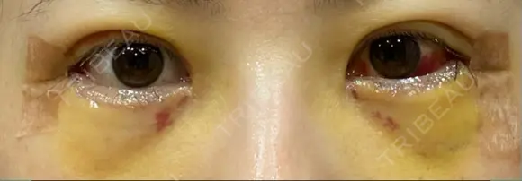 二重切開 / 目尻切開 / 上まぶたの脂肪取り / タレ目形成・グラマラスライン（切開） LIKI CLINIC KOBE DAY 6 メイン用