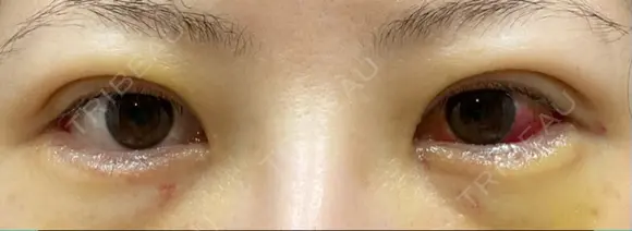 二重切開 / 目尻切開 / 上まぶたの脂肪取り / タレ目形成・グラマラスライン（切開） LIKI CLINIC KOBE DAY 8 メイン用