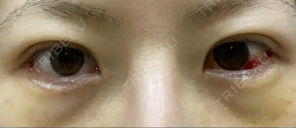 二重切開 / 目尻切開 / 上まぶたの脂肪取り / タレ目形成・グラマラスライン（切開） LIKI CLINIC KOBE DAY 10 メイン用