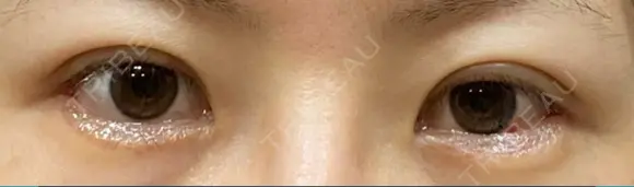 二重切開 / 目尻切開 / 上まぶたの脂肪取り / タレ目形成・グラマラスライン（切開） LIKI CLINIC KOBE DAY 18 メイン用