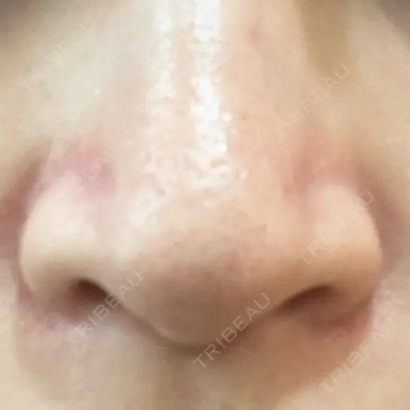 毛穴洗浄（ハイドラフェイシャルなど） STARS CLINIC AFTER メイン用