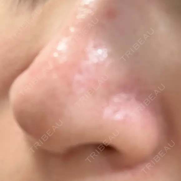 毛穴洗浄（ハイドラフェイシャルなど） STARS CLINIC DAY 0 メイン用