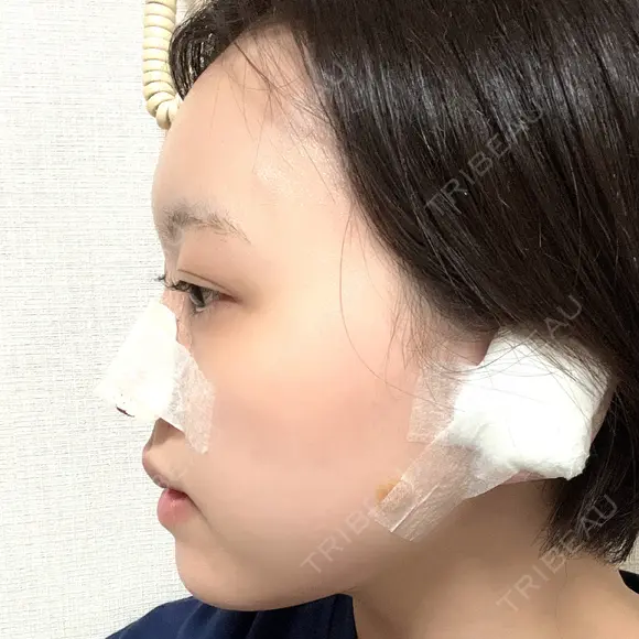 鼻尖形成（切開） / 軟骨移植 / ヒアルロン酸注入（涙袋） / ヒアルロン酸注入（唇） / ボトックス（口角） / ヒアルロン酸注入（額） 東京シンデレラ美容外科 池袋院 DAY 1 メイン用