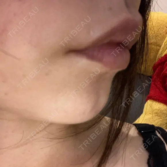 ヒアルロン酸注入（唇） / ボトックス（口角） / ボトックス（人中） ルラ美容クリニック 大宮院 / ルラスキンクリニック 大宮院 DAY 30 メイン用