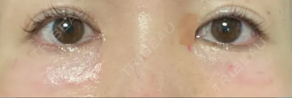 リジュラン 湘南美容クリニック 岡山院 DAY 1 メイン用