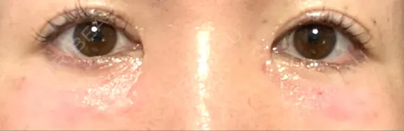 リジュラン 湘南美容クリニック 岡山院 DAY 2 メイン用