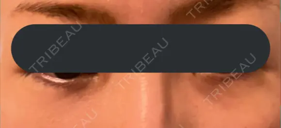 下まぶたの脂肪取り BRIGHTS beauty clinic DAY 0 メイン用