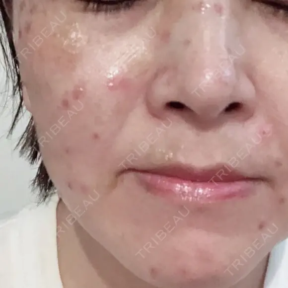 ほくろ・いぼ切除（肌） / シミ取りレーザー Jスキンクリニック 【J-SKIN clinic】 DAY 0 メイン用