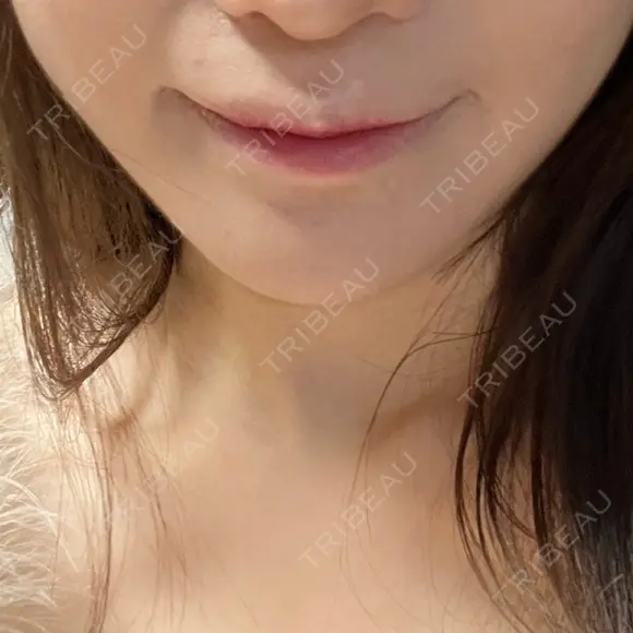 骨切り（あご） 銀座マイアミ美容外科 AFTER メイン用