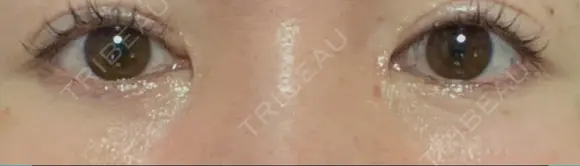 リジュラン 湘南美容クリニック 岡山院 DAY 3 メイン用