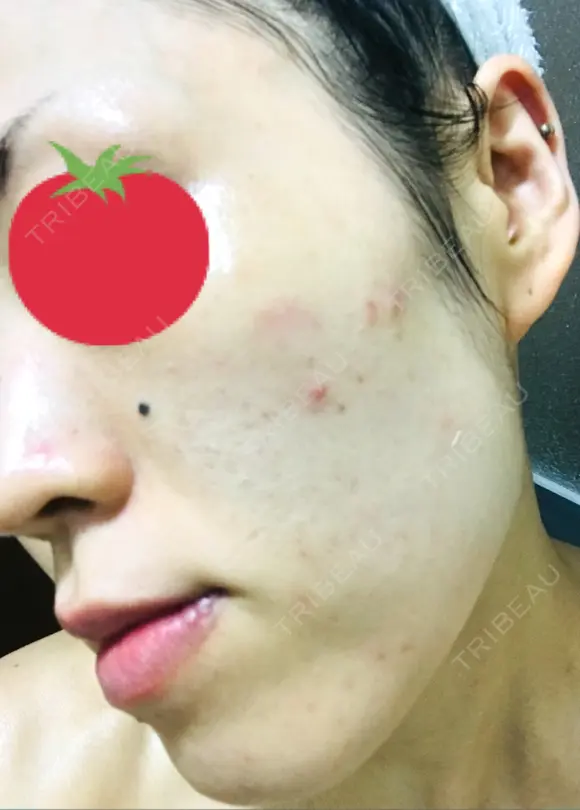 ピーリング（ニキビ・毛穴） / イオン導入 / フォトシルクプラス / ニキビ治療 ハニークリニック DAY 10 メイン用