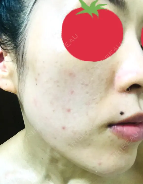 ピーリング（ニキビ・毛穴） / イオン導入 / フォトシルクプラス / ニキビ治療 ハニークリニック DAY 10 メイン用