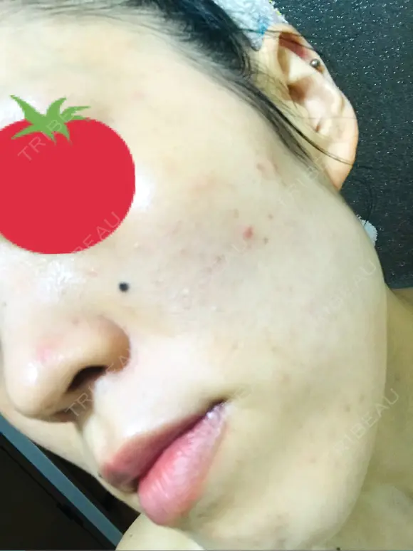 ピーリング（ニキビ・毛穴） / イオン導入 / フォトシルクプラス / ニキビ治療 ハニークリニック DAY 10 メイン用