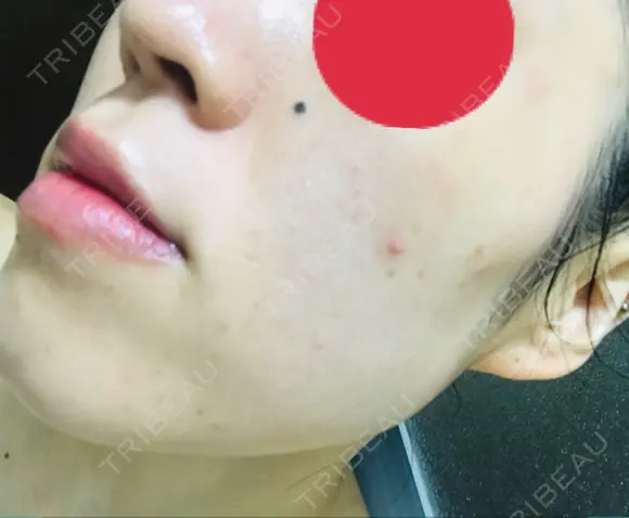 ピーリング（ニキビ・毛穴） / イオン導入 / フォトシルクプラス / ニキビ治療 ハニークリニック AFTER メイン用