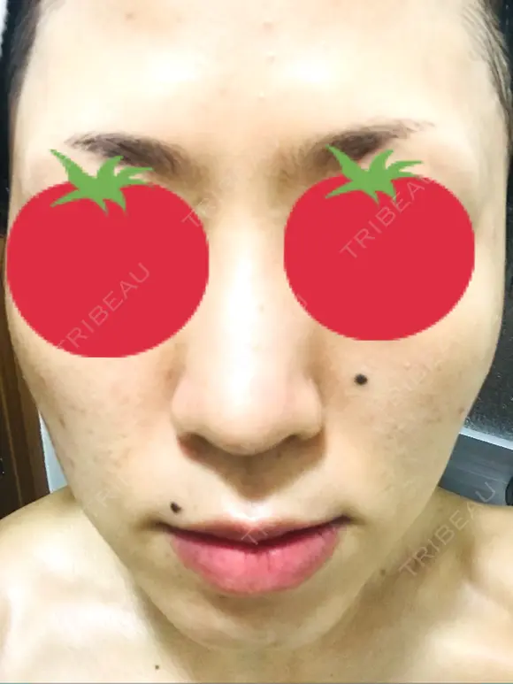 ピーリング（ニキビ・毛穴） / イオン導入 / フォトシルクプラス / ニキビ治療 ハニークリニック DAY 11 メイン用