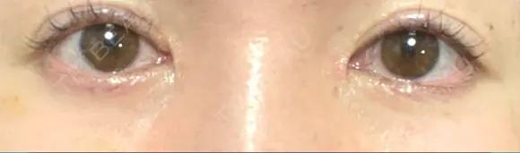 リジュラン 湘南美容クリニック 岡山院 DAY 4 メイン用