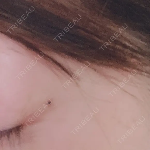 アートメイク（ほくろ） oneUPclinic AFTER メイン用