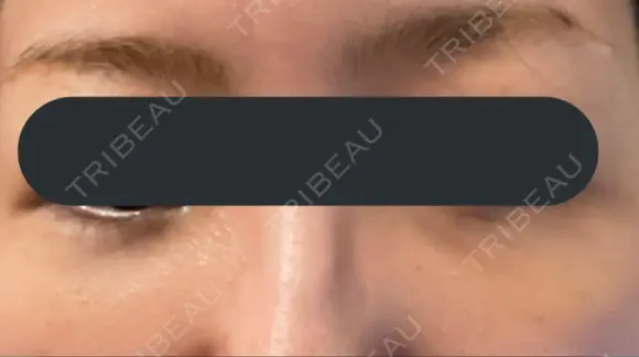 下まぶたの脂肪取り BRIGHTS beauty clinic DAY 3 メイン用