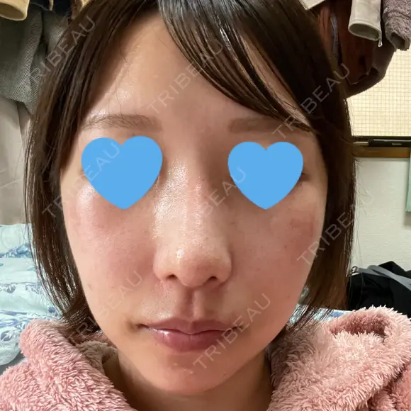 隆鼻術 / 鼻尖形成（切開） / 鼻中隔延長（切開） / 軟骨移植 / 骨切幅寄せ / 真皮移植 Zetith Beauty Clinic 銀座院 DAY 238 メイン用