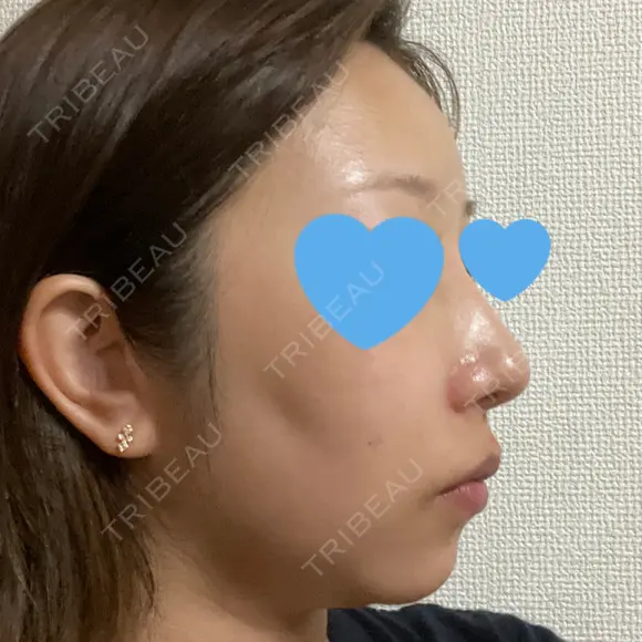 隆鼻術 / 鼻尖形成（切開） / 鼻中隔延長（切開） / 軟骨移植 / 骨切幅寄せ / 真皮移植 Zetith Beauty Clinic 銀座院 DAY 346 メイン用