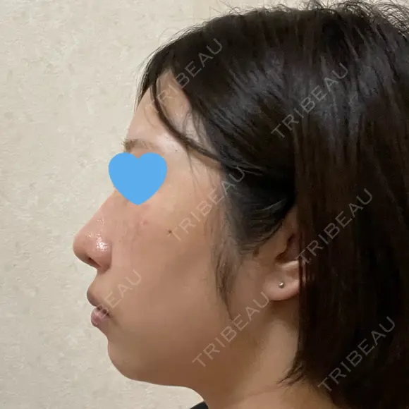 隆鼻術 / 鼻尖形成（切開） / 鼻中隔延長（切開） / 軟骨移植 / 骨切幅寄せ / 真皮移植 Zetith Beauty Clinic 銀座院 DAY 172 メイン用