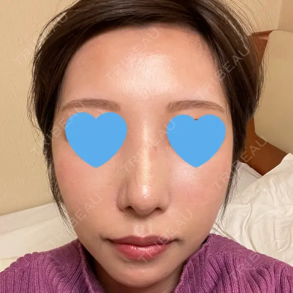 隆鼻術 / 鼻尖形成（切開） / 鼻中隔延長（切開） / 軟骨移植 / 骨切幅寄せ / 真皮移植 Zetith Beauty Clinic 銀座院 DAY 73 メイン用