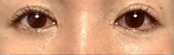 リジュラン 湘南美容クリニック 岡山院 DAY 5 メイン用