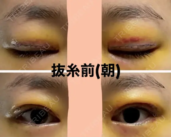 二重切開 / 眼瞼下垂（切開） / 上まぶたたるみ取り / 上まぶたの脂肪取り 城本クリニック 名古屋院 DAY 5 メイン用