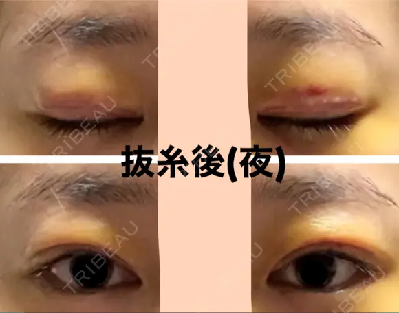 二重切開 / 眼瞼下垂（切開） / 上まぶたたるみ取り / 上まぶたの脂肪取り 城本クリニック 名古屋院 DAY 5 メイン用