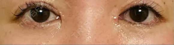 リジュラン 湘南美容クリニック 岡山院 DAY 6 メイン用