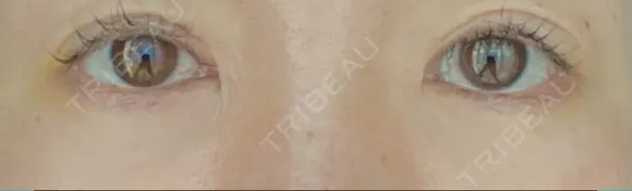 リジュラン 湘南美容クリニック 岡山院 DAY 7 メイン用