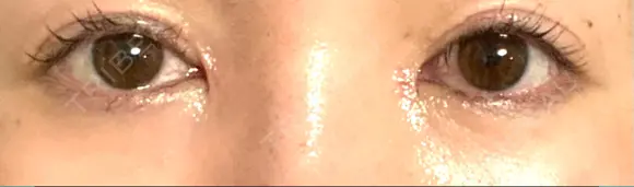 リジュラン 湘南美容クリニック 岡山院 AFTER メイン用