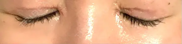 リジュラン 湘南美容クリニック 岡山院 DAY 8 メイン用