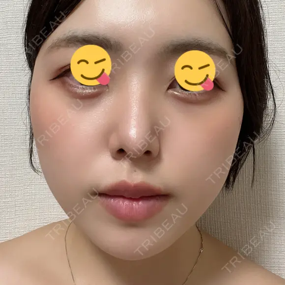 鼻尖形成（切開） / 軟骨移植 / ヒアルロン酸注入（涙袋） / ヒアルロン酸注入（唇） / ボトックス（口角） / ヒアルロン酸注入（額） 東京シンデレラ美容外科 池袋院 DAY 8 メイン用