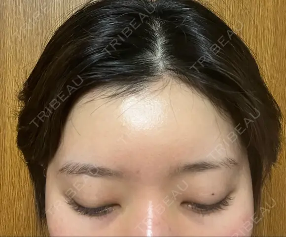 ヒアルロン酸注入（額） / ヒアルロン酸注入（こめかみ） BRIGHTS beauty clinic AFTER メイン用