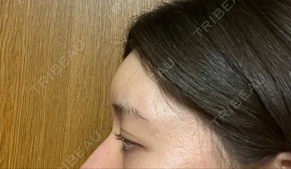 ヒアルロン酸注入（額） / ヒアルロン酸注入（こめかみ） BRIGHTS beauty clinic DAY 0 メイン用