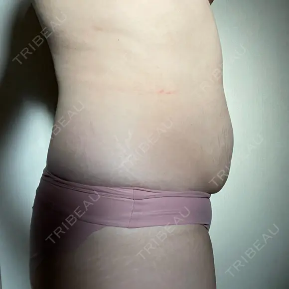 脂肪冷却（お腹） 品川スキンクリニック神戸院（※品川美容外科提携） DAY 37 メイン用