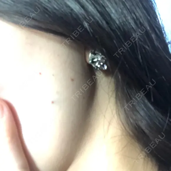 ボトックス（エラ・小顔） / 脂肪溶解注射（顔） あいちビューティークリニック DAY 0 メイン用