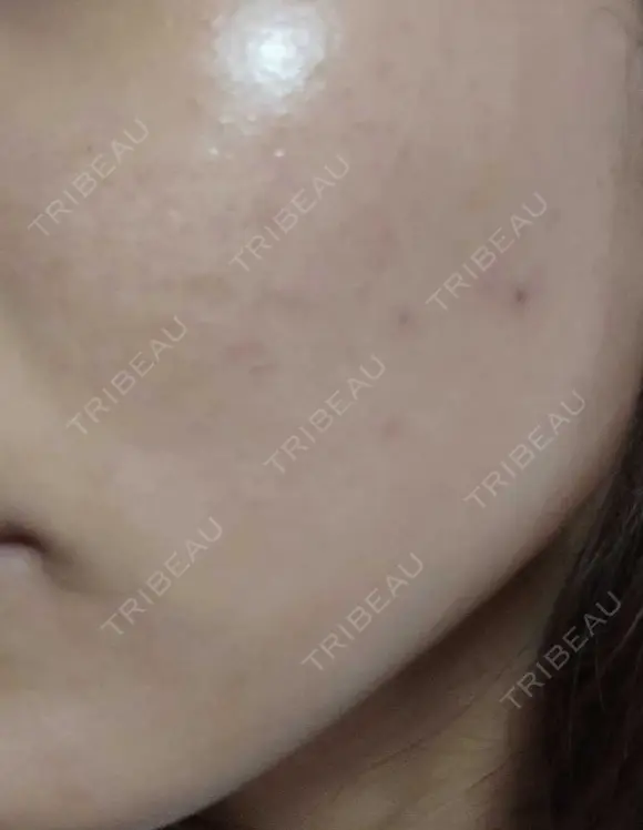 ピーリング（ニキビ・毛穴） 表参道スキンクリニック 大阪院 DAY 0 メイン用