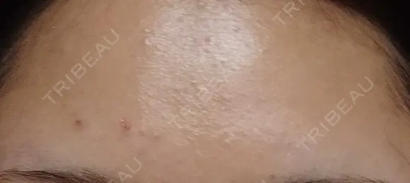 ピーリング（ニキビ・毛穴） 表参道スキンクリニック 大阪院 DAY 0 メイン用