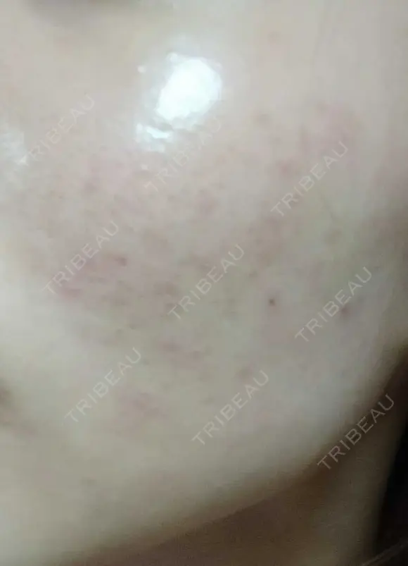 ピーリング（ニキビ・毛穴） 表参道スキンクリニック 大阪院 DAY 3 メイン用