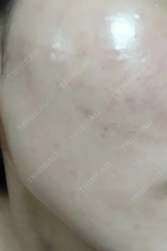 ピーリング（ニキビ・毛穴） 表参道スキンクリニック 大阪院 DAY 3 メイン用