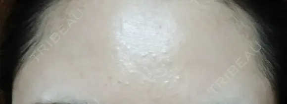 ピーリング（ニキビ・毛穴） 表参道スキンクリニック 大阪院 DAY 3 メイン用