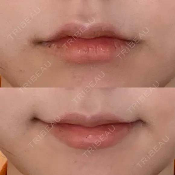 ヒアルロン酸注入（唇） / ボトックス（口角） グランメドクリニック茨木 DAY 0 メイン用