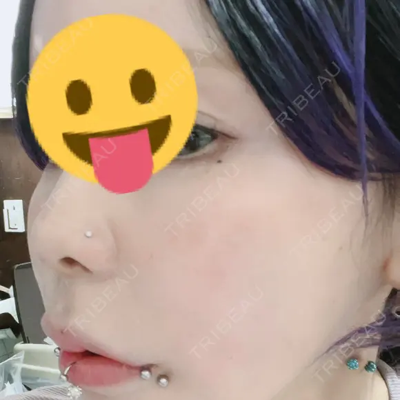 鼻尖形成（非切開） / 鼻中隔延長（非切開） ルラ美容クリニック銀座院 DAY 4 メイン用