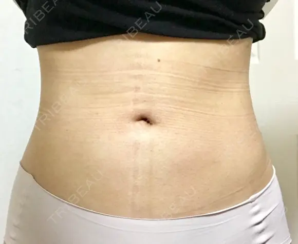 脂肪吸引（お腹） ドクターフィット（Dr.fit）クリニック DAY 50 メイン用