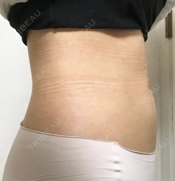 脂肪吸引（お腹） ドクターフィット（Dr.fit）クリニック DAY 50 メイン用