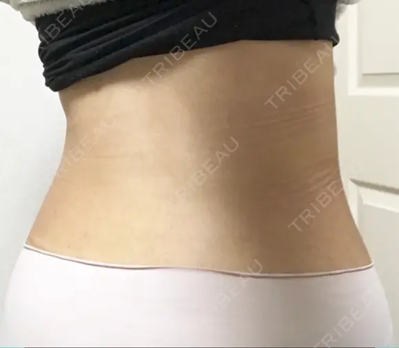 脂肪吸引（お腹） ドクターフィット（Dr.fit）クリニック DAY 50 メイン用