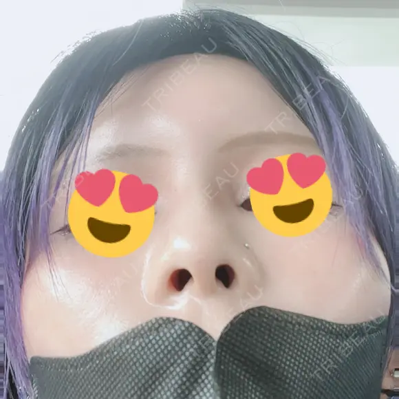 鼻尖形成（非切開） / 鼻中隔延長（非切開） ルラ美容クリニック銀座院 DAY 5 メイン用