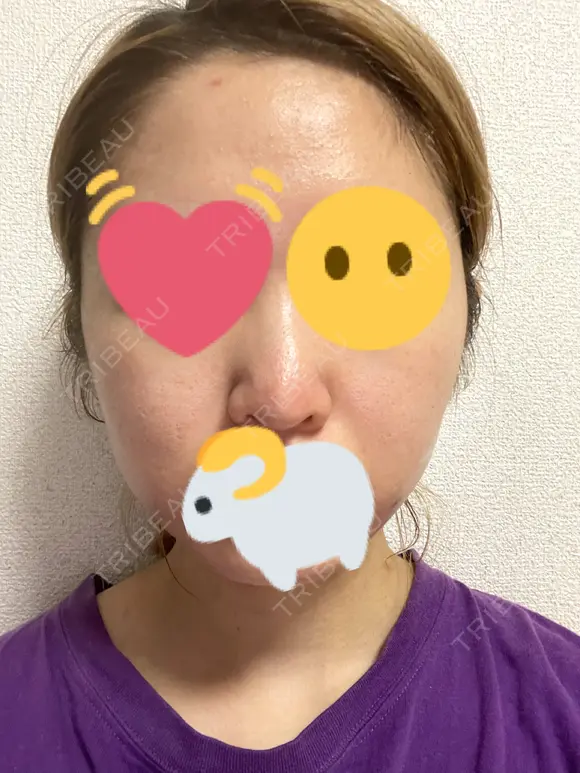 ピーリング（ニキビ・毛穴） / イオン導入 渋谷美容外科クリニック 新宿院 DAY 0 メイン用